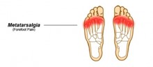metatarsalgia - dolore e infiammazione al piede